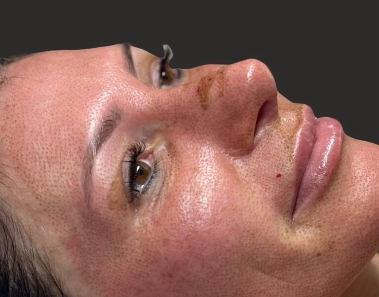 skin tightening treatment